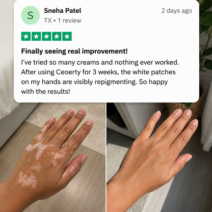 Herbal Vitiligo Cream